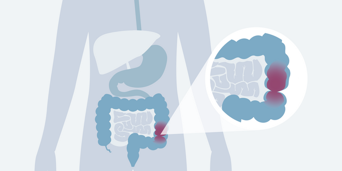 Der Reizdarm: Ursachen, Symptome und Behandlung bei Reizdarmsyndrom (RDS)